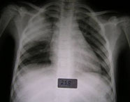 Chest X-ray of Pneumonia patient