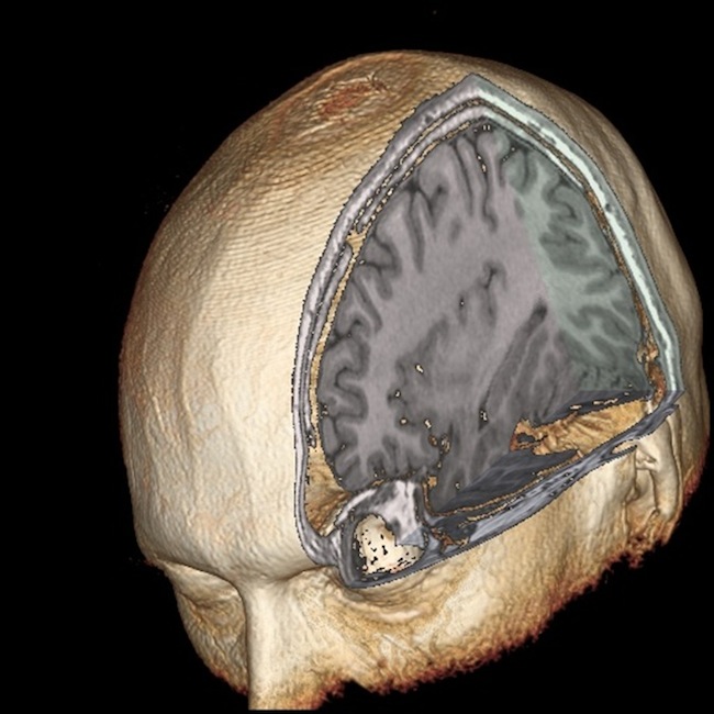 3D MRI of a brain