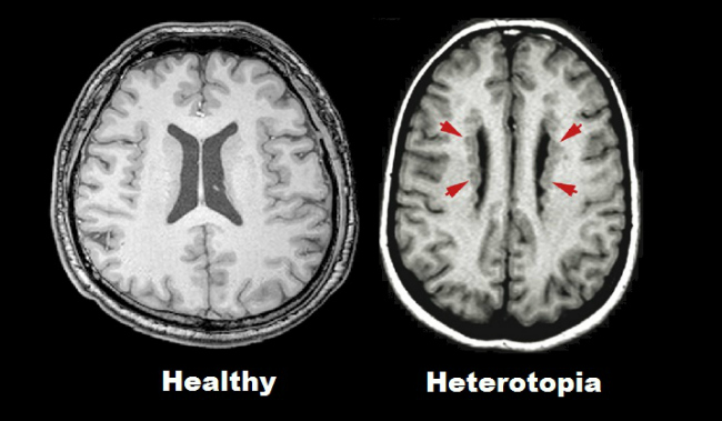 heterotopia vs normal - cropped