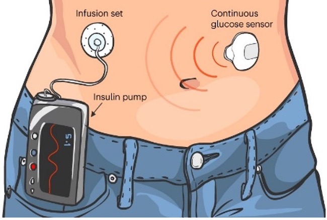 Drawing of an automated insulin device connected to a continuous glucose monitor