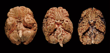 concussed brains