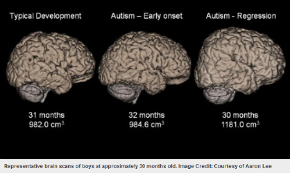 autism - comparative brains
