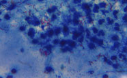 TB bacteria thumbnail