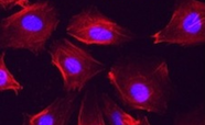 Invasive breast cancer cells tn