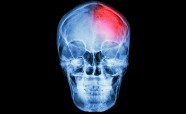 Thumbnail-Concussion-Image
