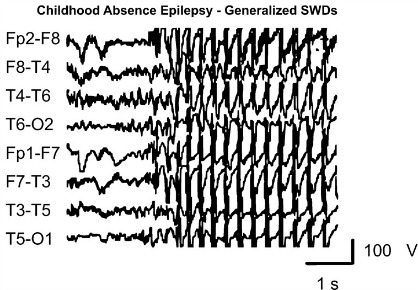 absence epilepsy EEG