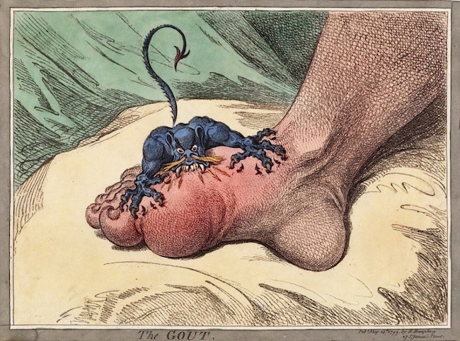 The Gout by James Gillray in 1799: a small fierce creature with sharp teeth is biting into a swollen foot at the base of the big toe.