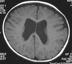 Periventricular neuronal heterotopia brain scan