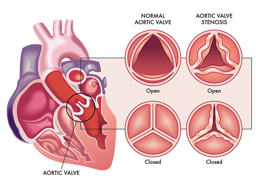 Diagram showing normal aortic valve and valve with aortic stenosis image