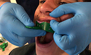 Secondary school student receiving a dental mould thumbnail