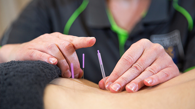 Patient receiving acupuncture at the Dunedin Physiotherapy Clinic