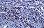 Microscopy image of macrophages reacting with CD86 in the stroma adjacent to infiltrating squamous cell carcinoma islands