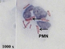 A single neutrophil (PMN) isolated from the lung fluid of a tuberculosis patient