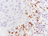 Immunohistochemical staining for CD66b+ neutrophils surrounding a non-melanoma skin cancer